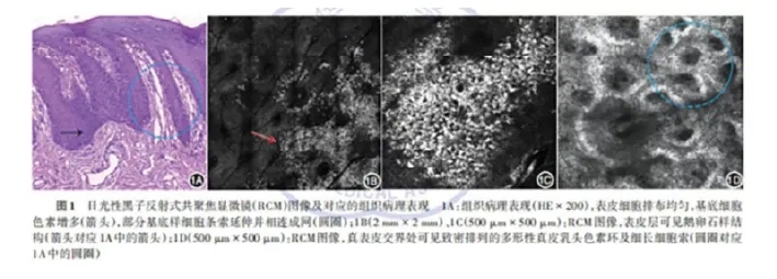 学术前沿丨常见非黑素细胞性皮肤肿瘤的反射式共聚焦显微镜特征专家共识(2025版)-04.jpg