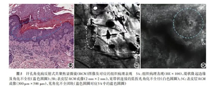 学术前沿丨常见非黑素细胞性皮肤肿瘤的反射式共聚焦显微镜特征专家共识(2025版)-08.jpg
