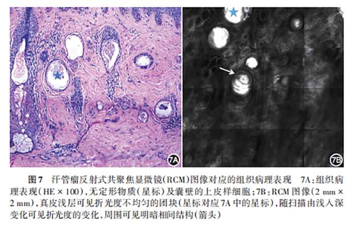 学术前沿丨常见非黑素细胞性皮肤肿瘤的反射式共聚焦显微镜特征专家共识(2025版)-10.jpg