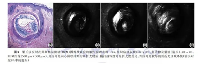 学术前沿丨常见非黑素细胞性皮肤肿瘤的反射式共聚焦显微镜特征专家共识(2025版)-11.jpg