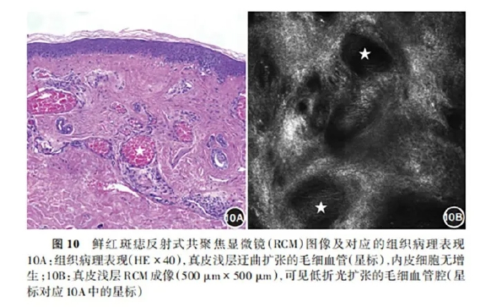 学术前沿丨常见非黑素细胞性皮肤肿瘤的反射式共聚焦显微镜特征专家共识(2025版)-13.jpg