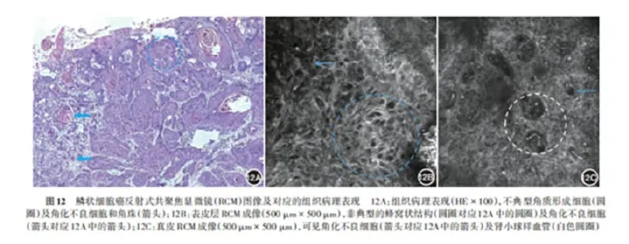 学术前沿丨常见非黑素细胞性皮肤肿瘤的反射式共聚焦显微镜特征专家共识(2025版)-16.jpg