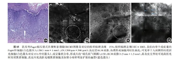 学术前沿丨常见非黑素细胞性皮肤肿瘤的反射式共聚焦显微镜特征专家共识(2025版)-19.jpg