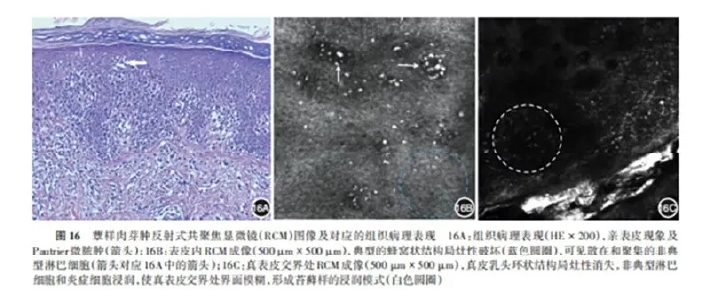 学术前沿丨常见非黑素细胞性皮肤肿瘤的反射式共聚焦显微镜特征专家共识(2025版)-20.jpg